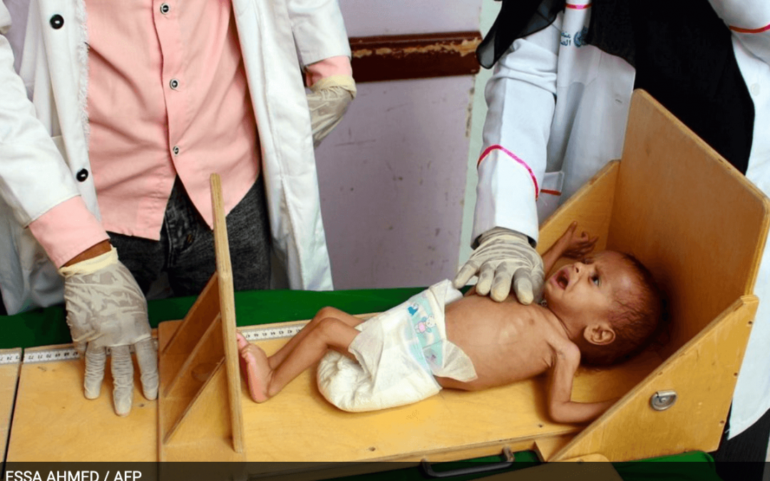 La desnutrición de los niños en Yemen