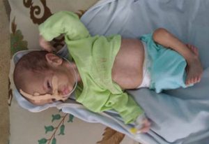desnutrición infantil en Yemen