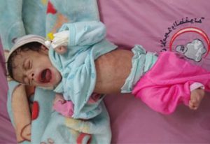 desnutrición infantil en Yemen