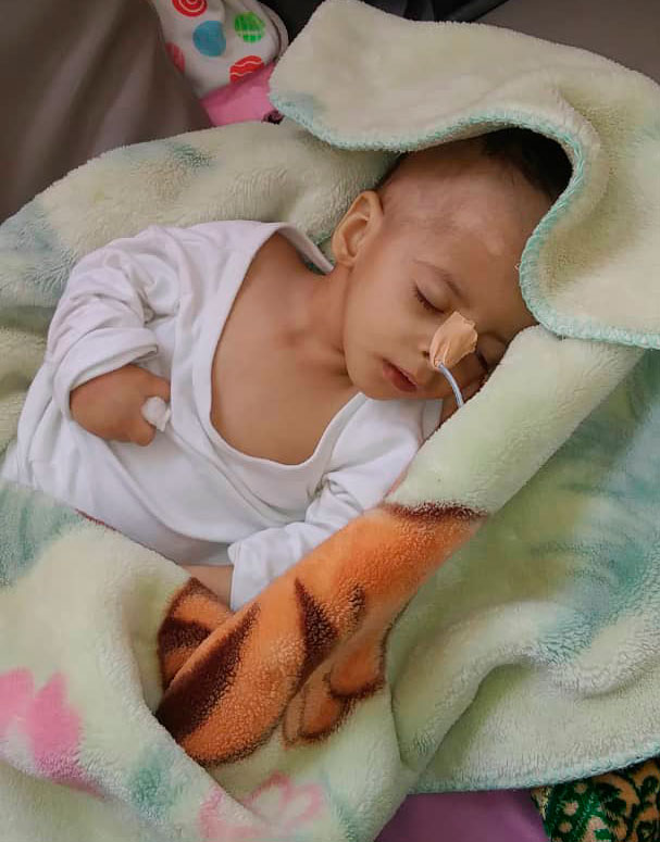 niño en Yemen con desnutrición aguda desnutrición aguda en Yemen