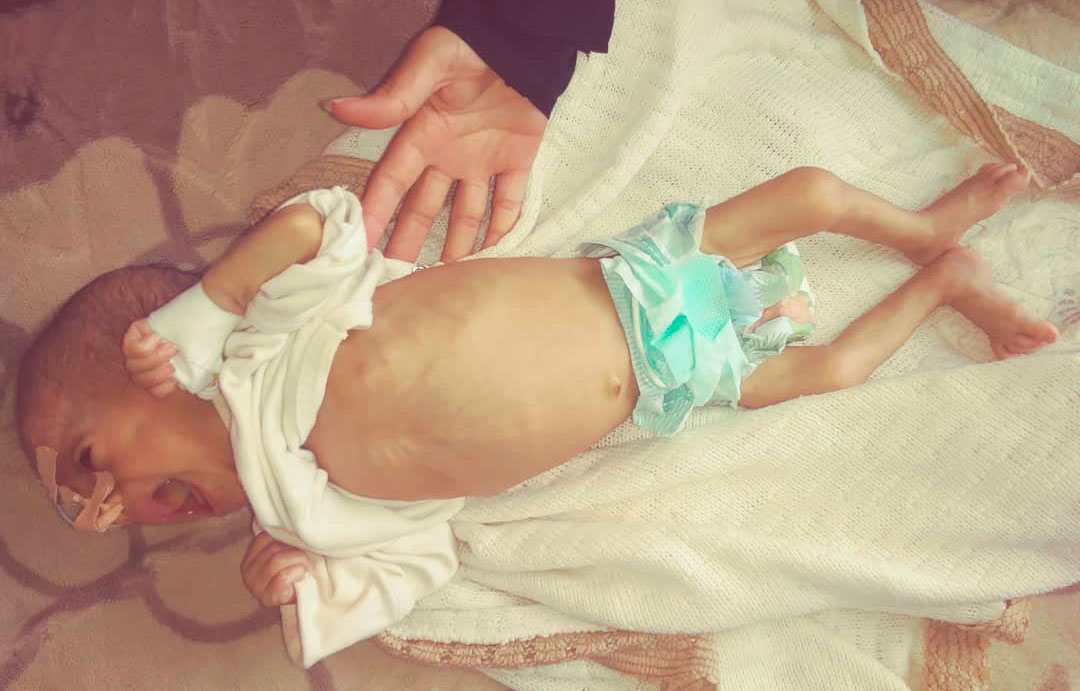 niño en Yemen con desnutrición aguda desnutrición aguda en Yemen