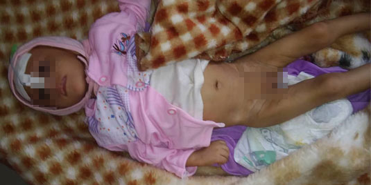 desnutricion infantil niña yemení desnutricion infantil niña en Yemen