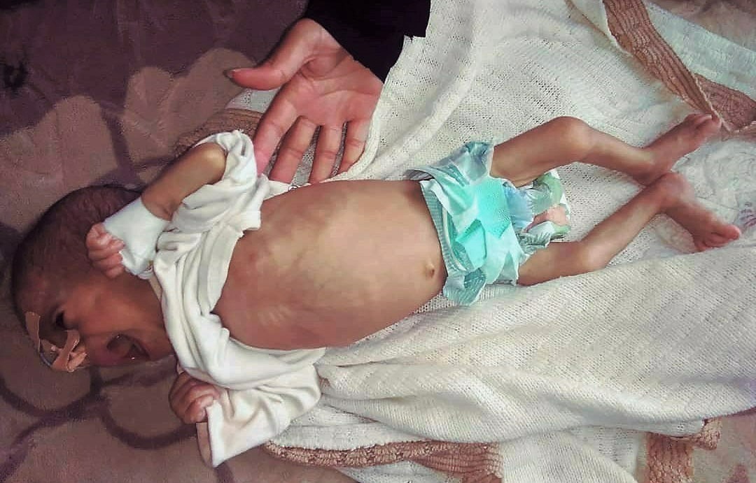 Desnutrición Yemen Desnutrición Yemen
